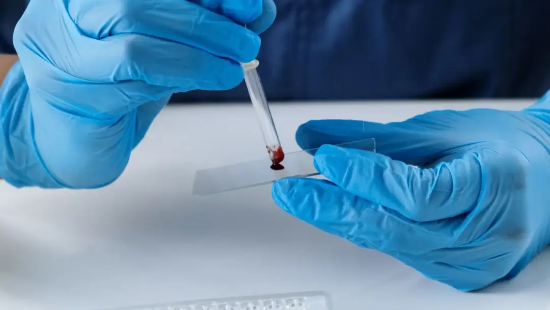 Gota de sangre sobre una lámina de vidrio, preparada para observarse al microscopio